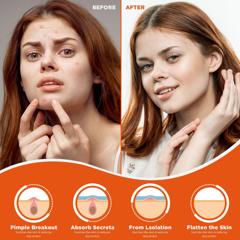 Hydrocolloid Pimple Patches | Pimple Healing Patches | Lootiva